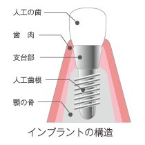 インプラント